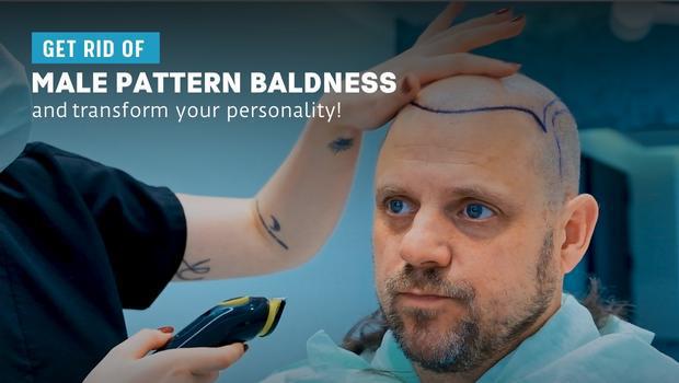Everything You Need To Know About Male Pattern Baldness