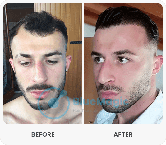 After-Before