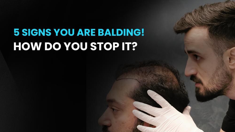 5 Signs you are Balding