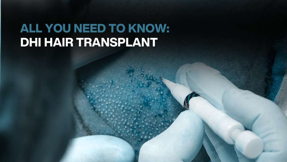 8000 grafts hair transplant