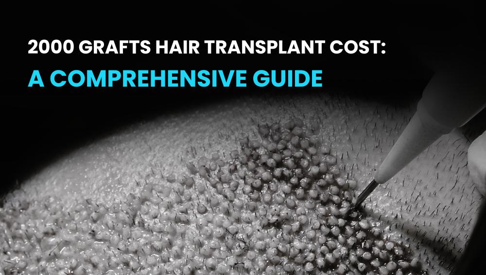 2000 Grafts Hair Transplant Cost