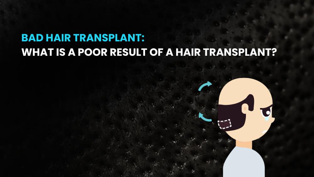Bad Hair Transplant What Is a Poor Result of a Hair Transplant
