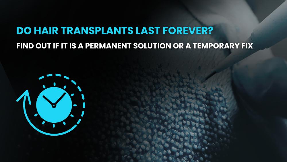 Do hair transplants last forever