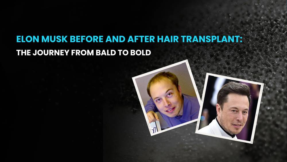 Elon Musk Before and After Hair Transplant
