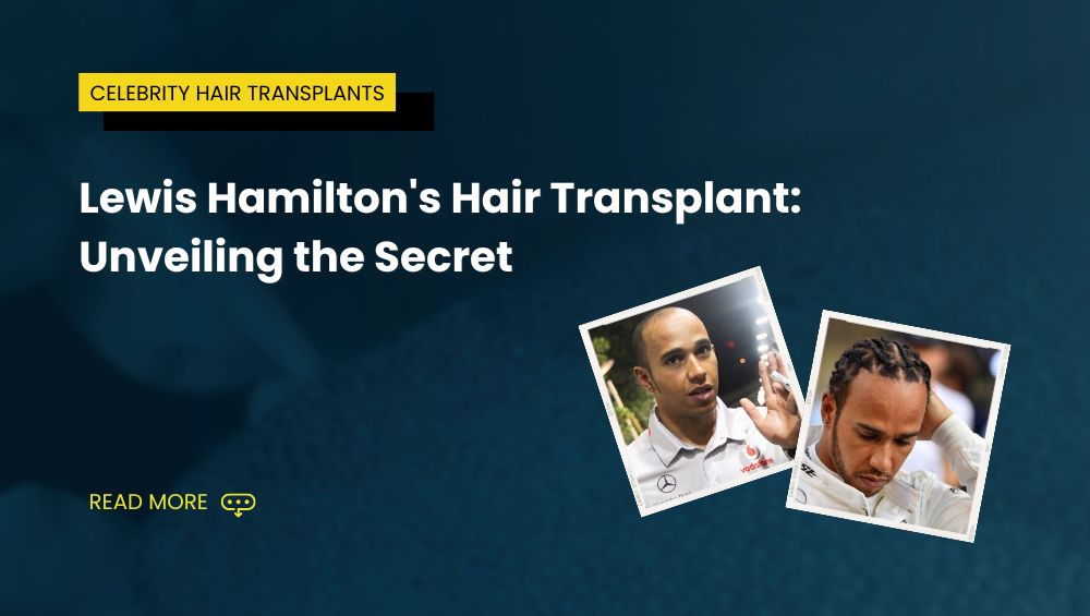 Lewis Hamiltons Hair Transplant