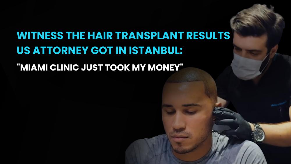Witness the hair transplant results US Attorney got in Istanbul
