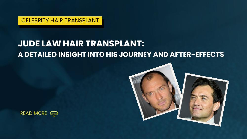 Jude Law Hair Transplant A Detailed Insight into His Journey and After effects
