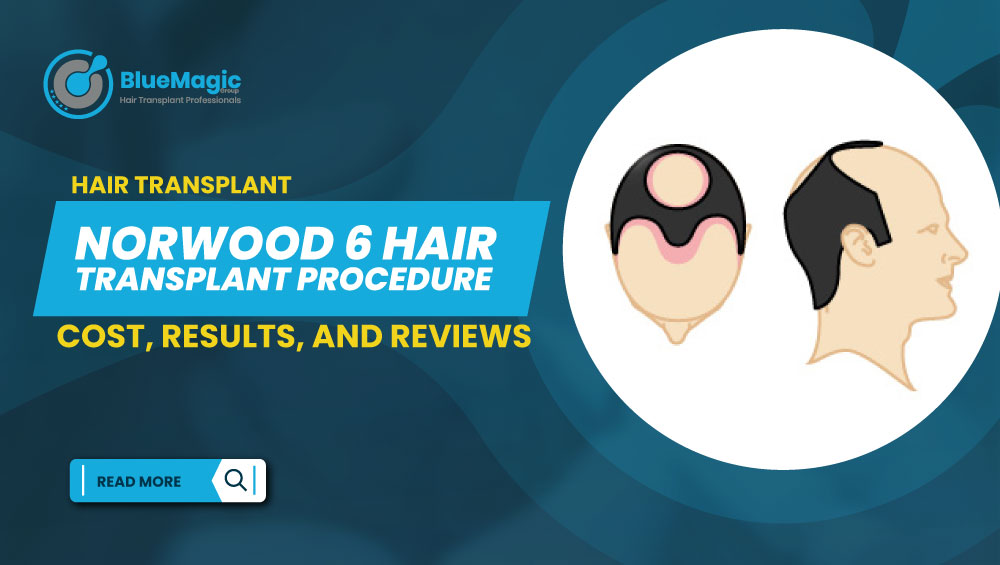 Norwood 6 Hair Transplant Procedure Costs Results and Reviews