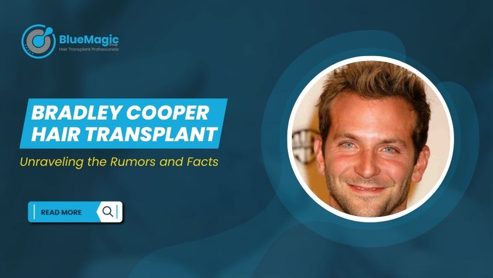 Bradley Cooper Hair Transplant 1
