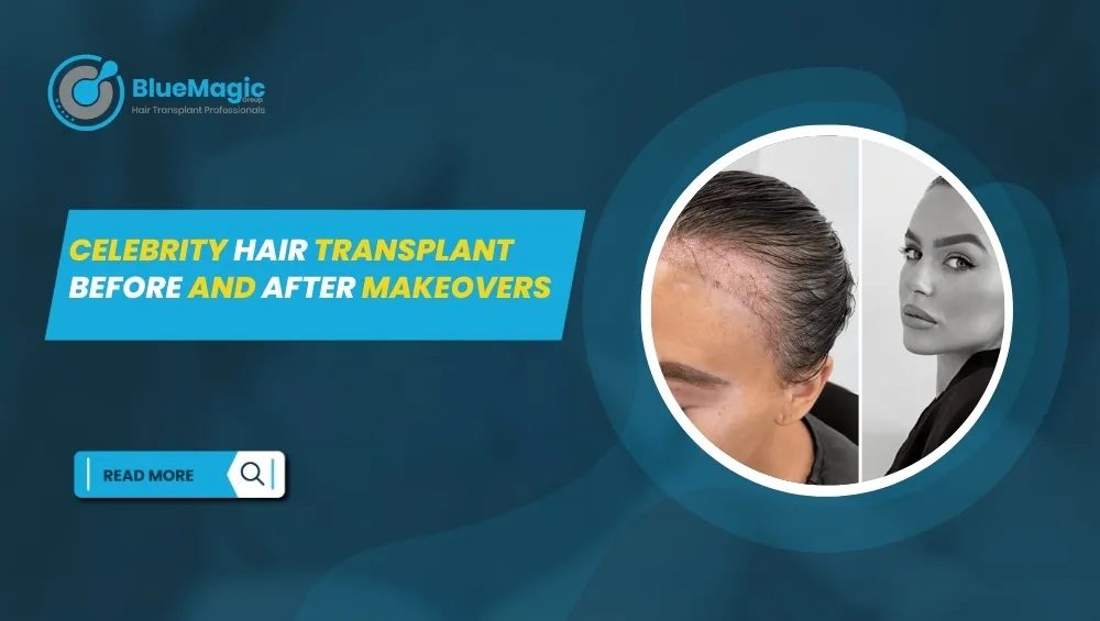 celebrity hair transplants