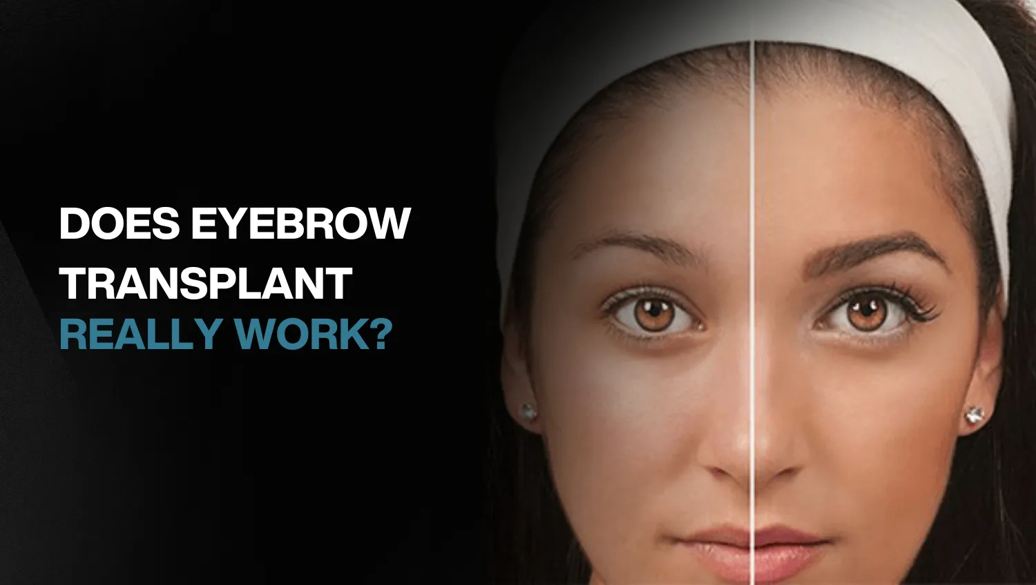 eyebrows transplant