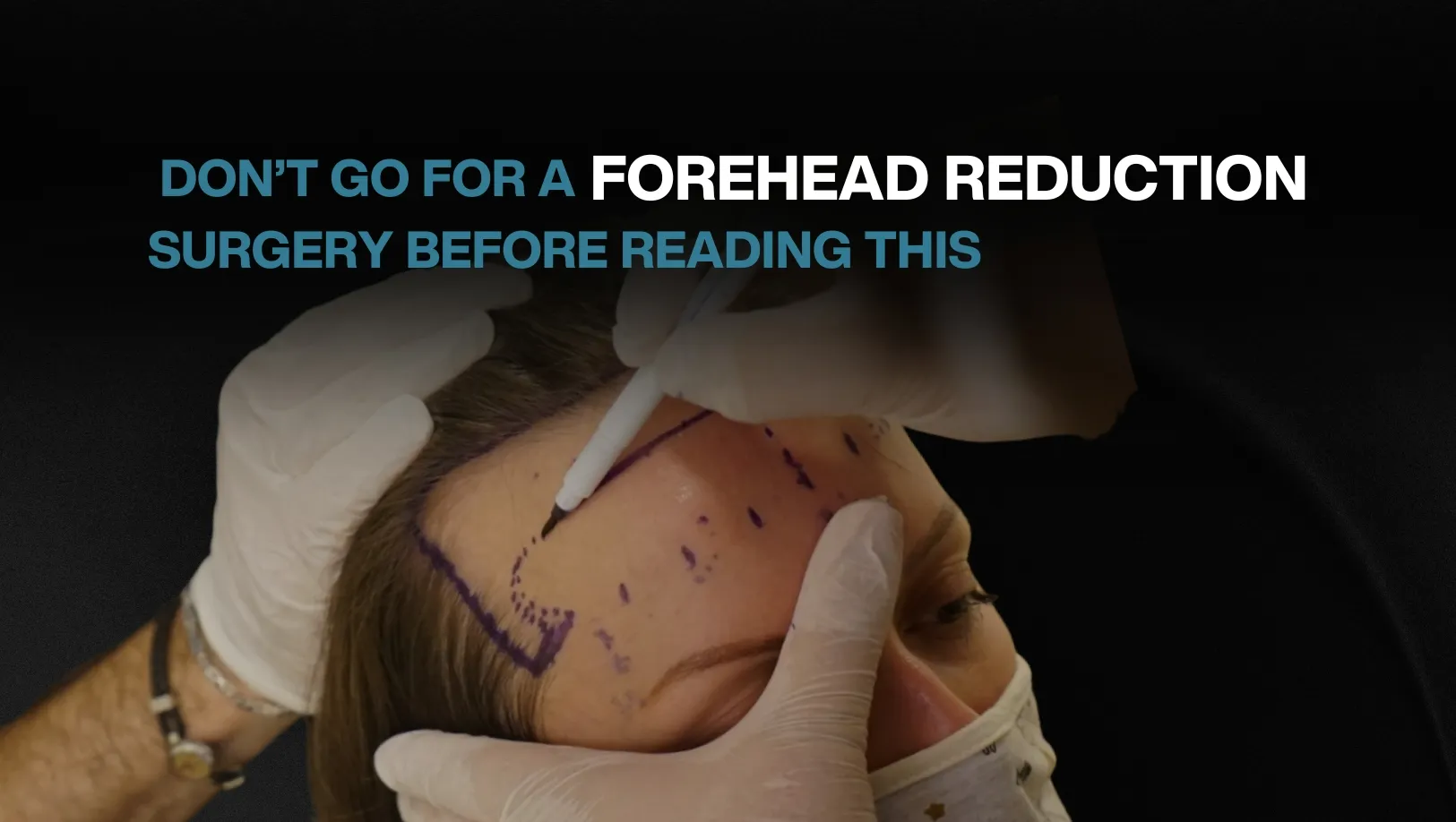 forehead reduction