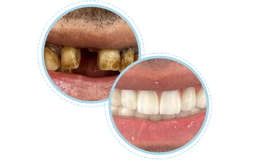 Before and after dental smile makeover results