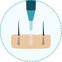 hair transplant Step