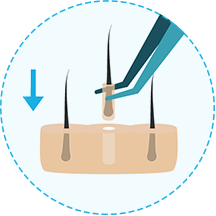 hair transplant