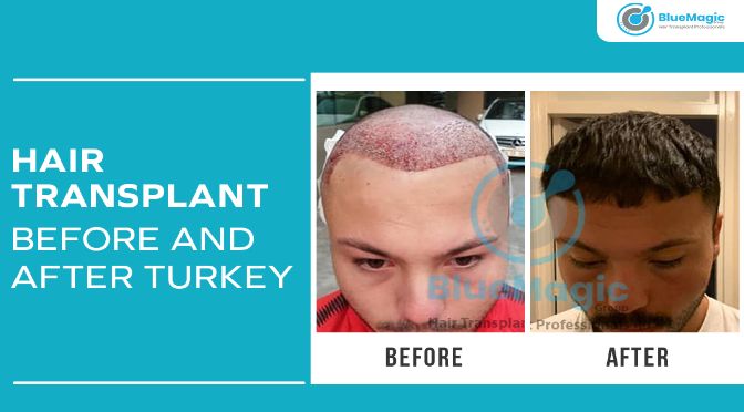 Blue Magic Hair Clinic Turkey - Hair Transplant in Istanbul - wide 4