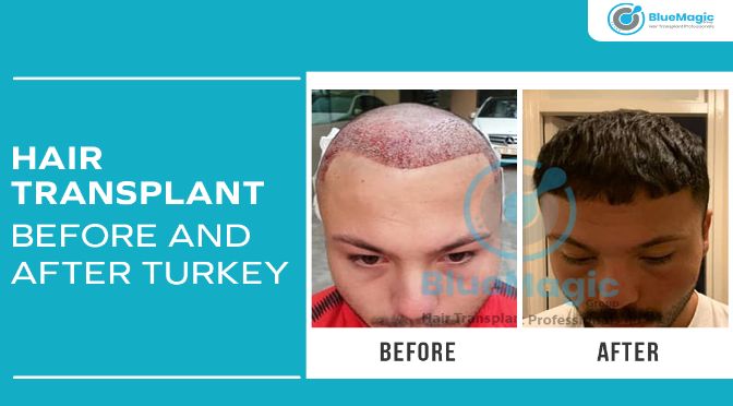 Blue Magic Hair Transplant Reviews - wide 3