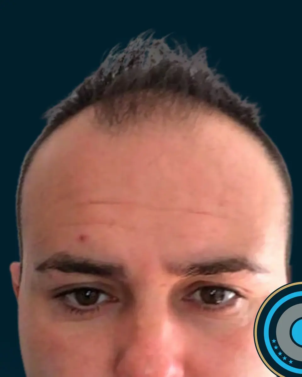 The same patient before the hair transplant