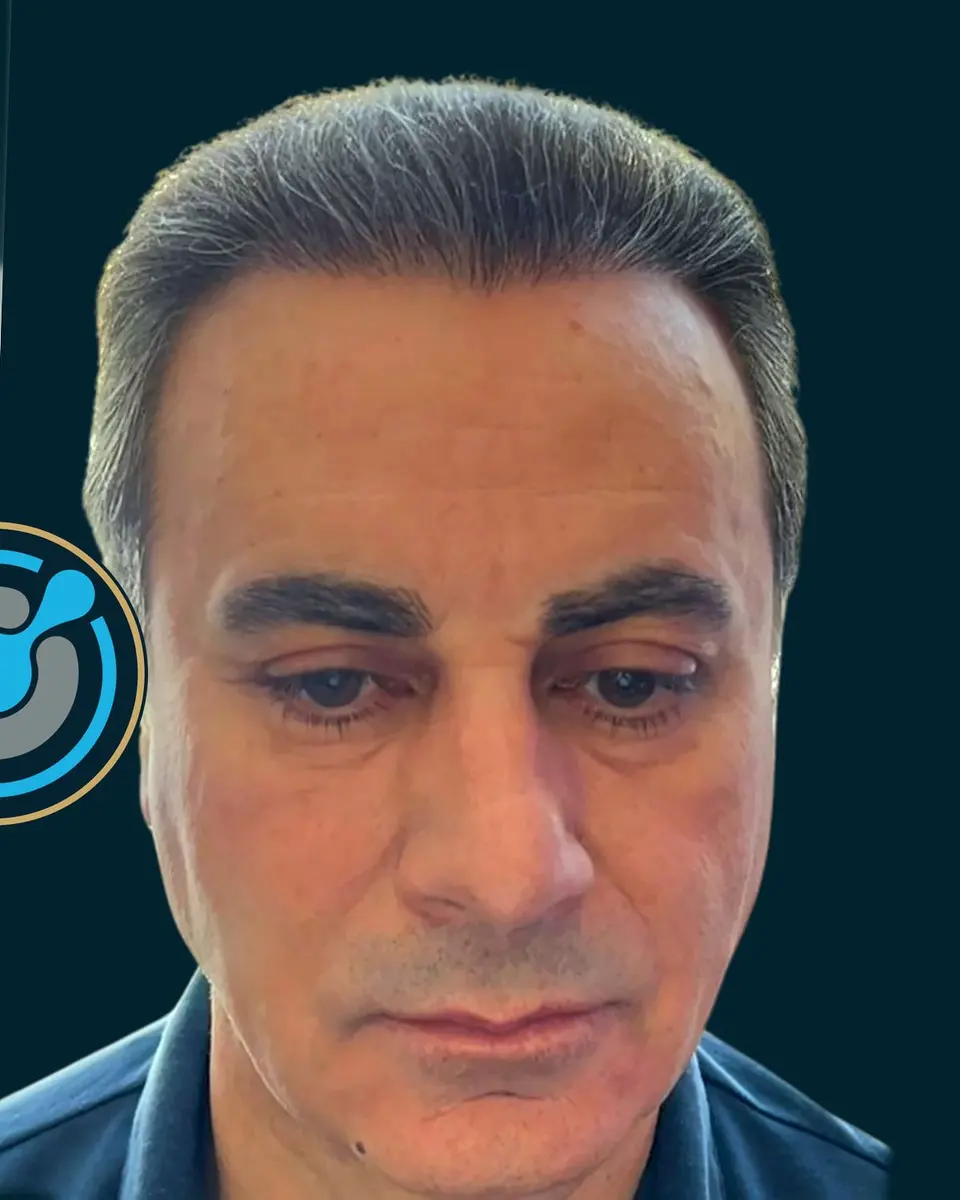 Pacient i vërtetë i BlueMagic Group Clinic pas mbjelljes së flokëve: 4.000 grafte, DHI, 2 seanca, fotografuar pas 8 muaj, pamje ballore