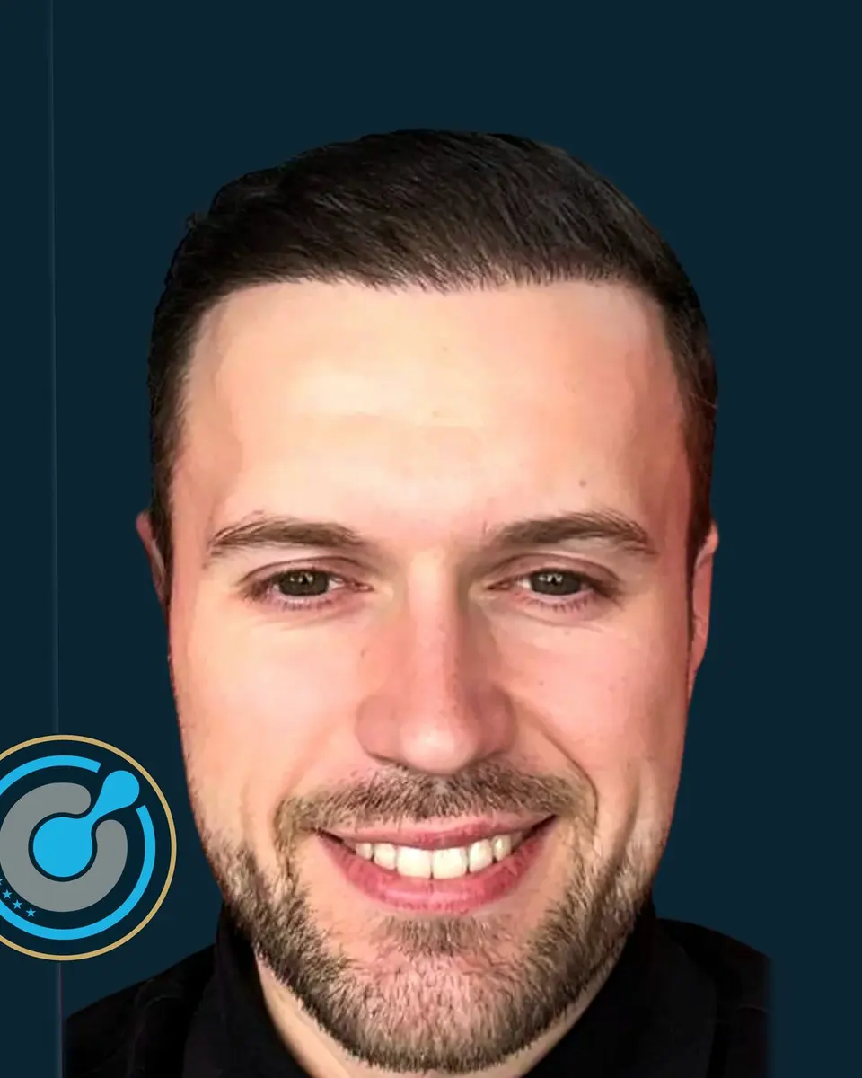 Real BlueMagic Group Clinic patient after the hair transplant: 5,700 grafts, DHI, 2 sessions, photographed at 12 months