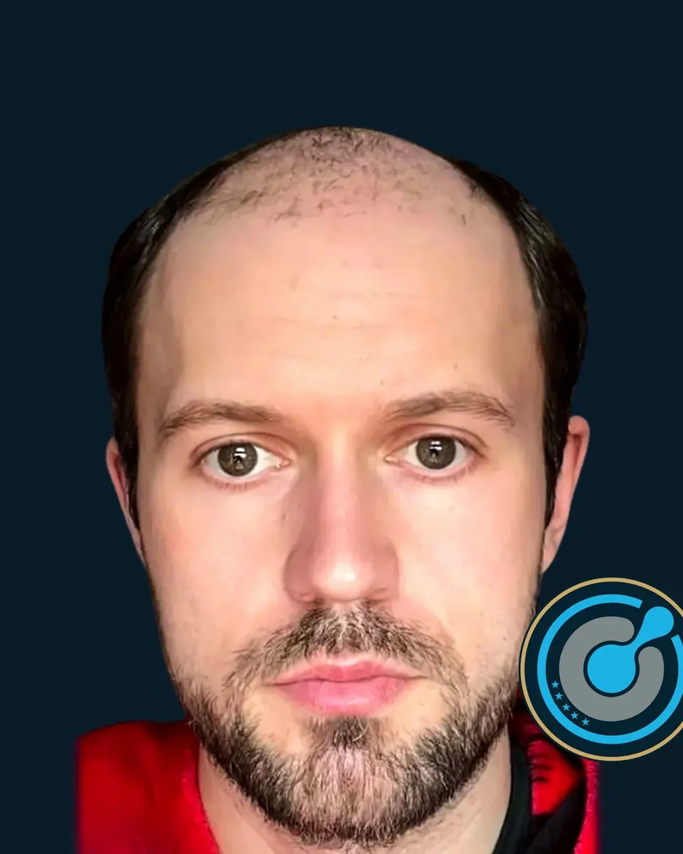 The same patient before the hair transplant
