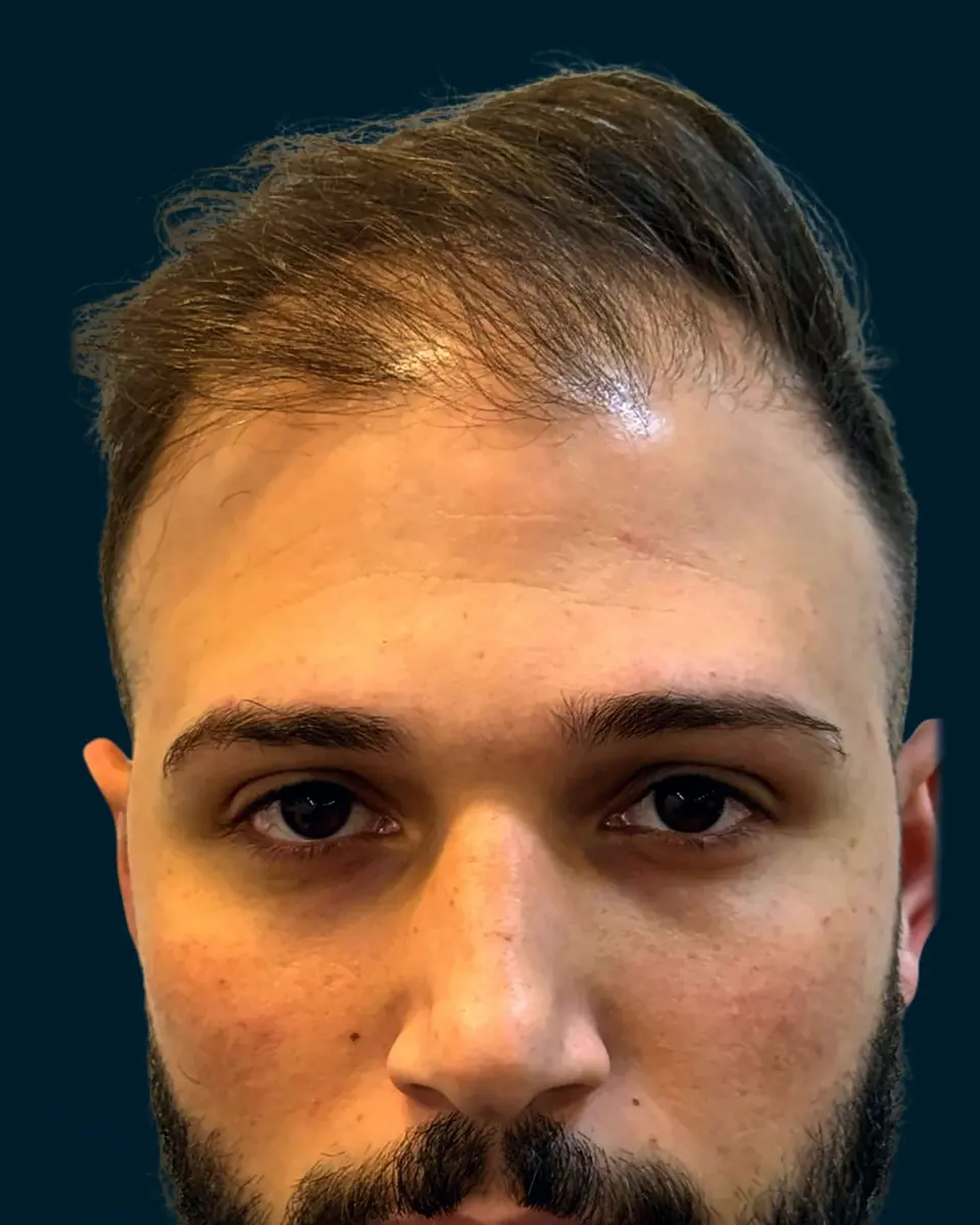 The same patient before the hair transplant