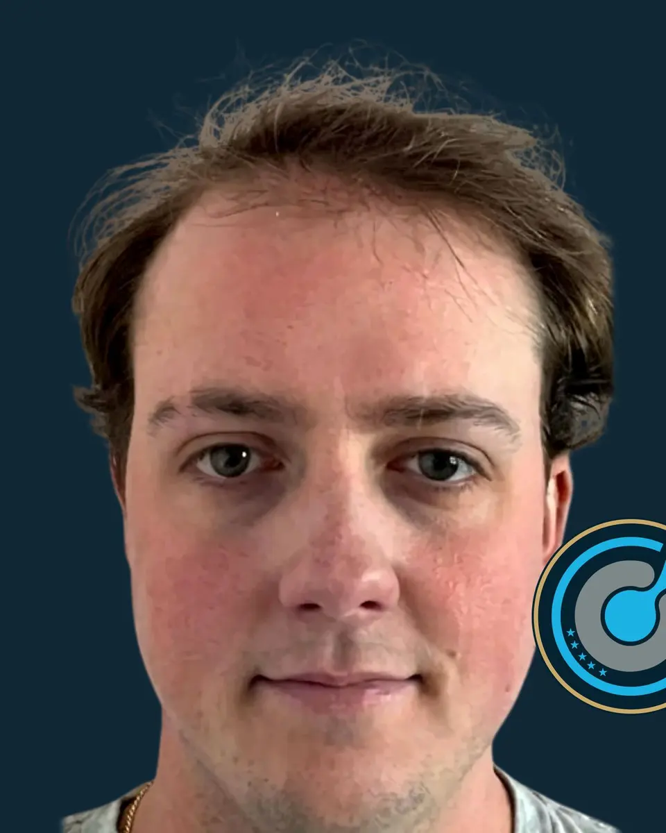 The same patient before the hair transplant