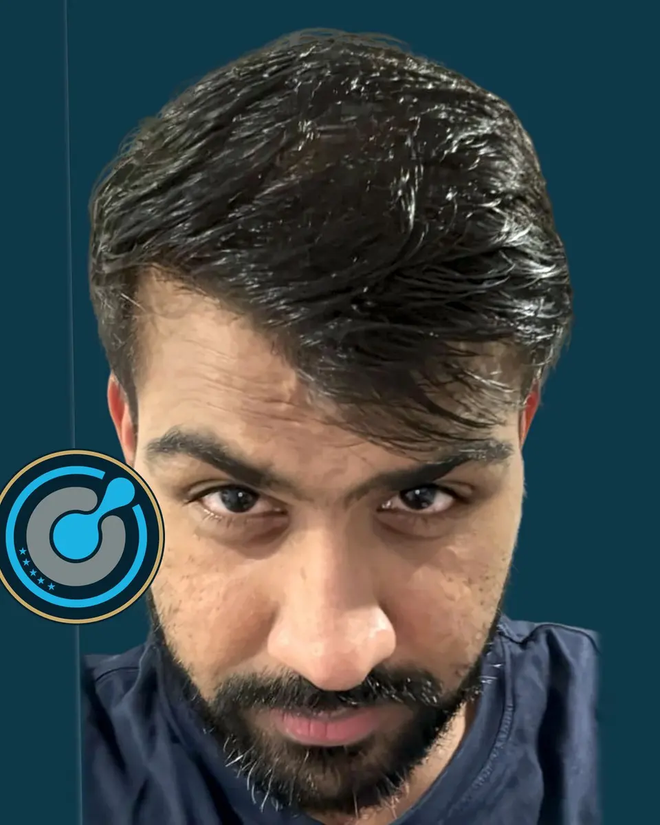 Real BlueMagic Group Clinic patient after the hair transplant: 5,300 grafts, DHI, 2 sessions, photographed at 12 months