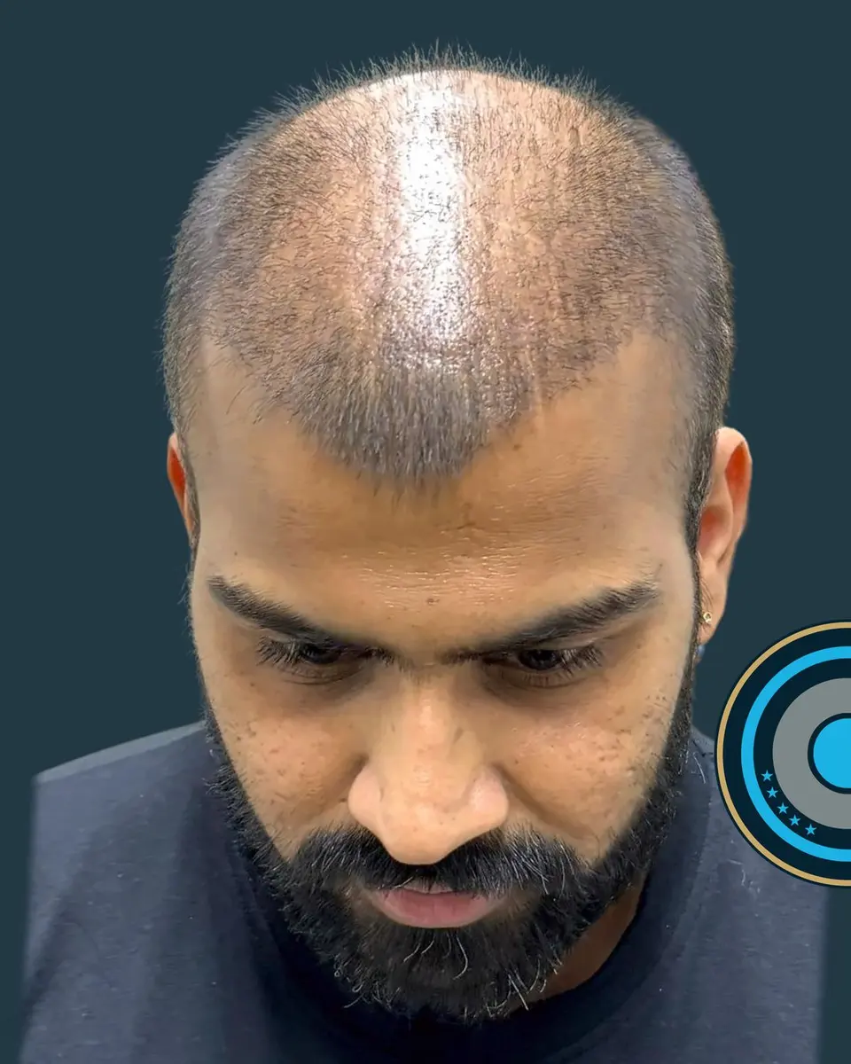 The same patient before the hair transplant