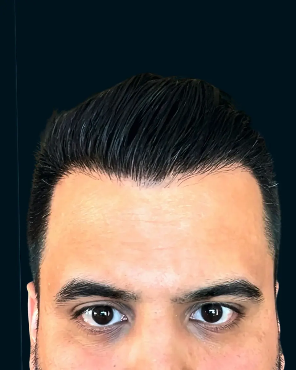 Real BlueMagic Group Clinic patient after the hair transplant: 5,200 grafts, DHI, 2 sessions, photographed at 12 months