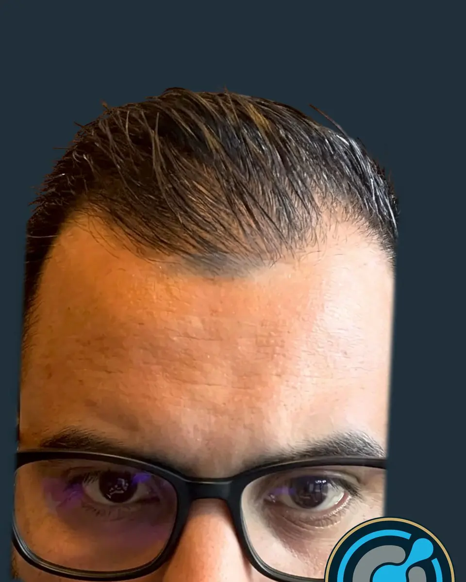 The same patient before the hair transplant