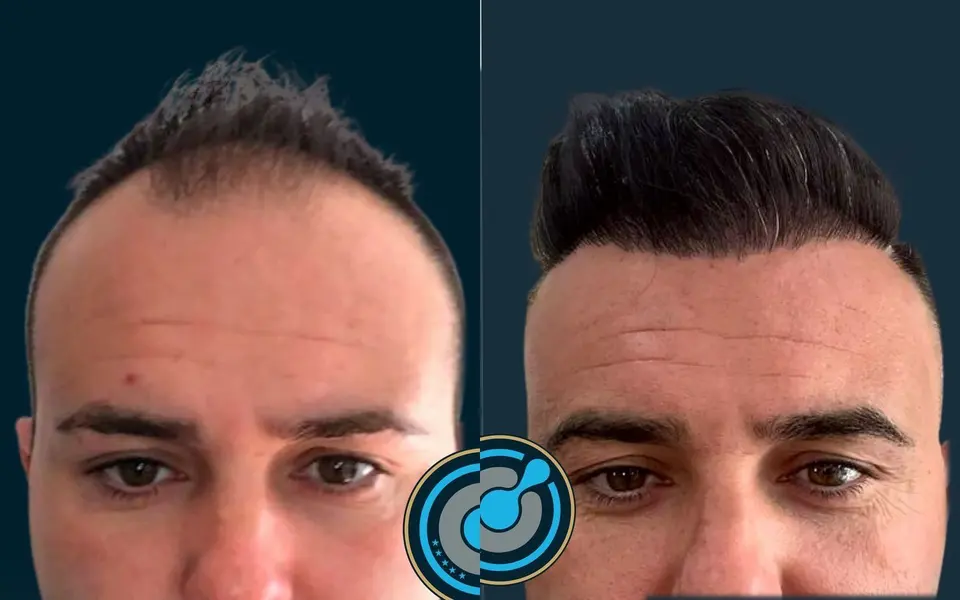 Before and after: 5,400 grafts, DHI, 1 session, photographed at 12 months