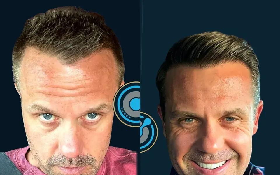 Before and after: DHI hair transplant, 4,600 grafts, 2 sessions, 7 months