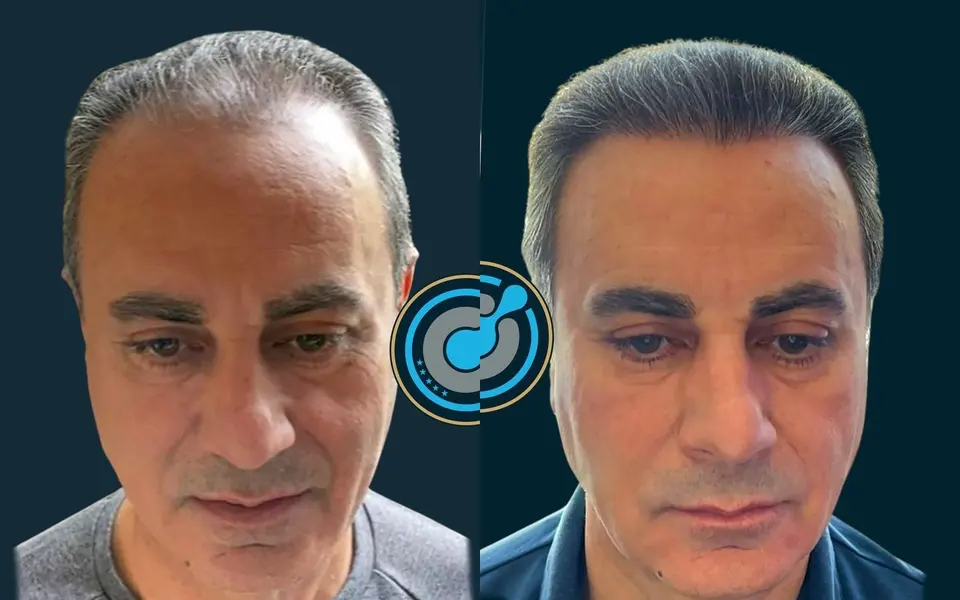 Para dhe pas mbjelljes së flokëve në BlueMagic Group Clinic: 4.000 grafte, DHI, 2 seanca, vija e flokëve. Majtas: para (pamje ballore). Djathtas: 8 muaj pas (pamje ballore).