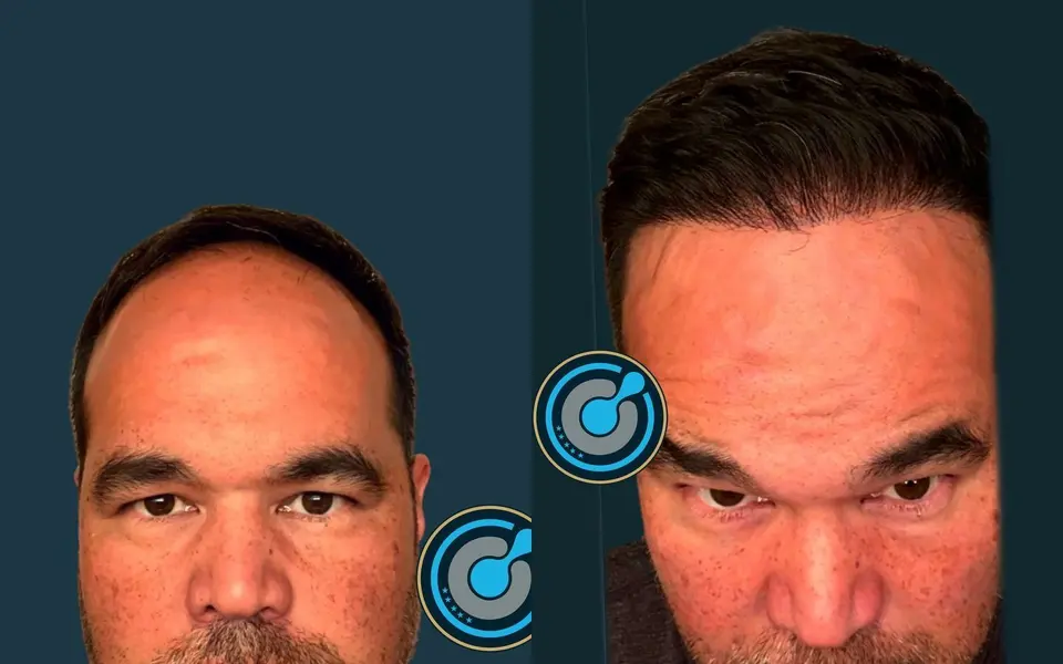 Before and after: DHI hair transplant, 5,000 grafts, 2 sessions, 12 months
