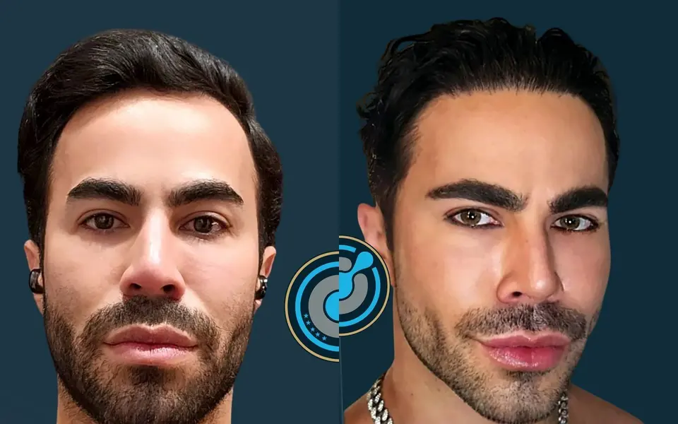 Para dhe pas mbjelljes së flokëve në BlueMagic Group Clinic: 3.600 grafte, DHI, 1 seancë, vija e flokëve, tëmthat. Majtas: para (pamje ballore). Djathtas: 8 muaj pas (pamje ballore).