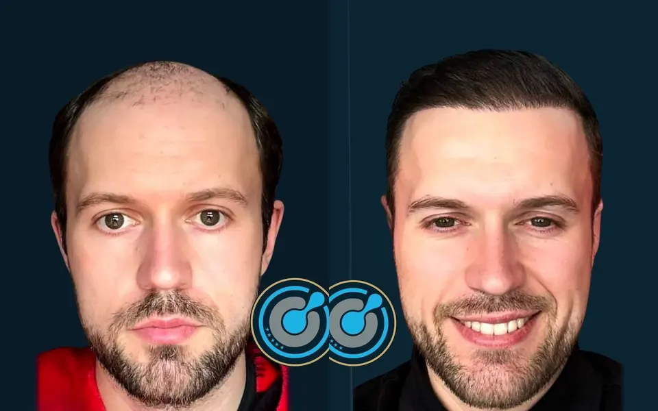 Real BlueMagic Group Clinic patient, before and after: 5,700 grafts, DHI, 2 sessions, photographed at 12 months