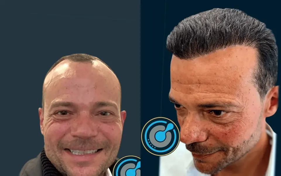 Before and after: 4,000 grafts, DHI, 1 session, photographed at 12 months