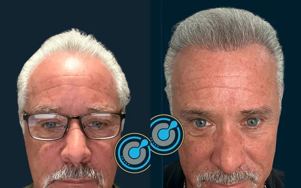 Before and after: DHI hair transplant, 4,600 grafts, 2 sessions, 12 months