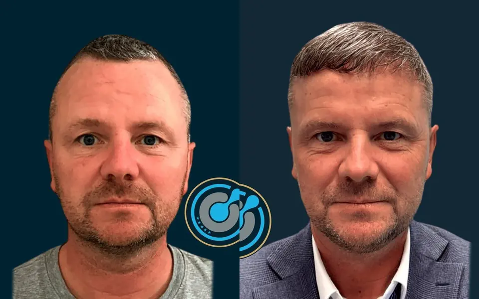 Before and after: DHI hair transplant, 5,000 grafts, 1 session, 12 months