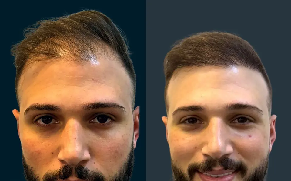 Before and after: 4,200 grafts, DHI, 2 sessions, photographed at 12 months