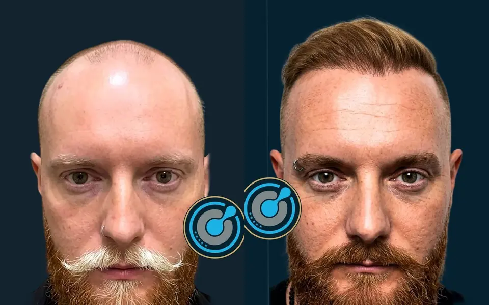 Before and after: 5,800 grafts, Sapphire FUE, 1 session, photographed at 6 months
