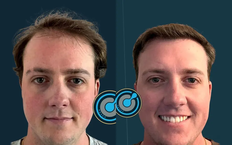 Before and after: 4,300 grafts, DHI, 1 session, photographed at 6 months