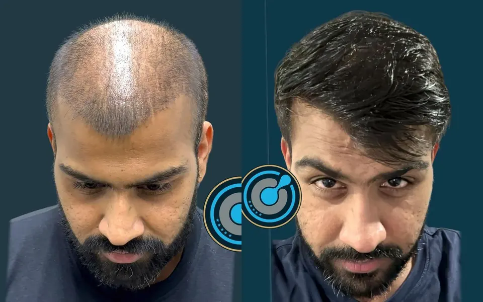 Before and after: 5,300 grafts, DHI, 2 sessions, photographed at 12 months
