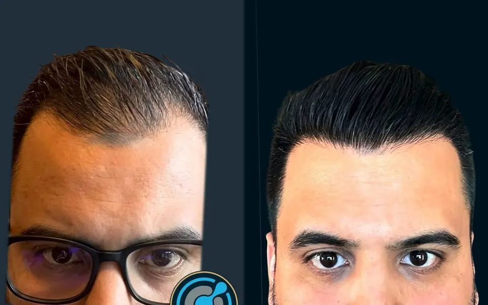 Para dhe pas mbjelljes së flokëve në BlueMagic Group Clinic: 5.200 grafte, DHI, 2 seanca, vija e flokëve. Majtas: para (pamje ballore). Djathtas: 12 muaj pas (pamje ballore).