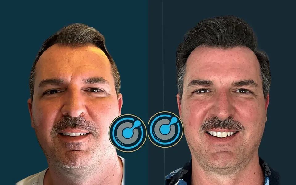Para dhe pas mbjelljes së flokëve në BlueMagic Group Clinic: 4.200 grafte, DHI, 2 seanca, vija e flokëve. Majtas: para (pamje ballore). Djathtas: 12 muaj pas (pamje ballore).