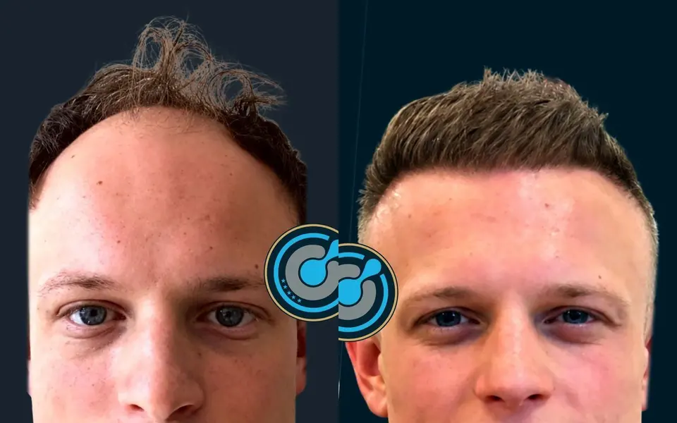 Before and after: 5,300 grafts, DHI, 2 sessions, photographed at 12 months