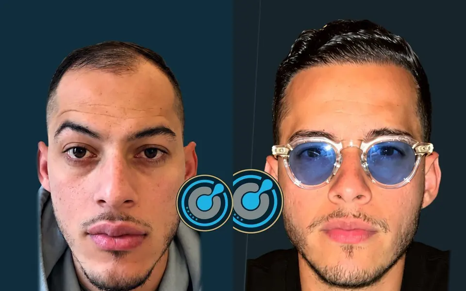 Before and after: DHI hair transplant, 5,900 grafts, 2 sessions, 9 months