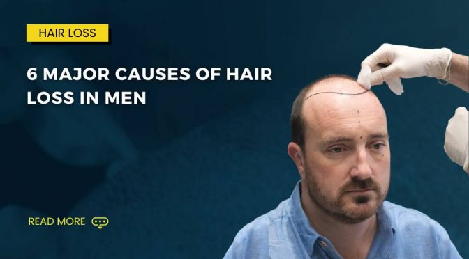 6 Major Causes Of Hair Loss In Men