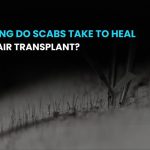 How long do scabs take to heal after hair transplant